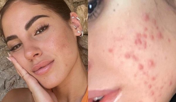 Cinegiornale.net giulia-de-lellis-e-il-suo-rapporto-con-lacne-scopri-cosa-e-successo-600x350 Giulia De Lellis e il suo rapporto con l’Acne: Scopri cosa è successo Gossip News  
